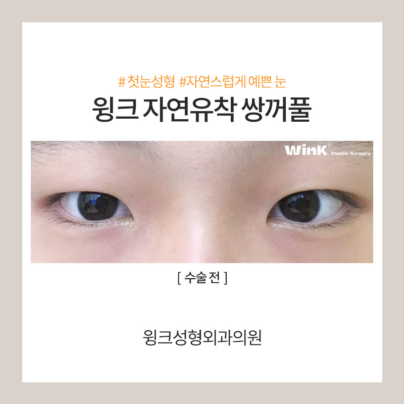 자연유착쌍수후기 자연유착전후를 알아본다면 윙크성형외과가 정답! 관련 이미지 3