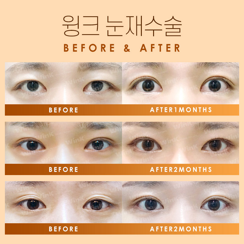 마지막 눈재수술을 위한 선택! 윙크성형외과 눈재수술 관련 이미지 6