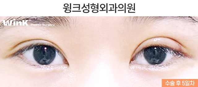 Is It Okay to Have Double Eyelid Surgery on Only One Side? image 3