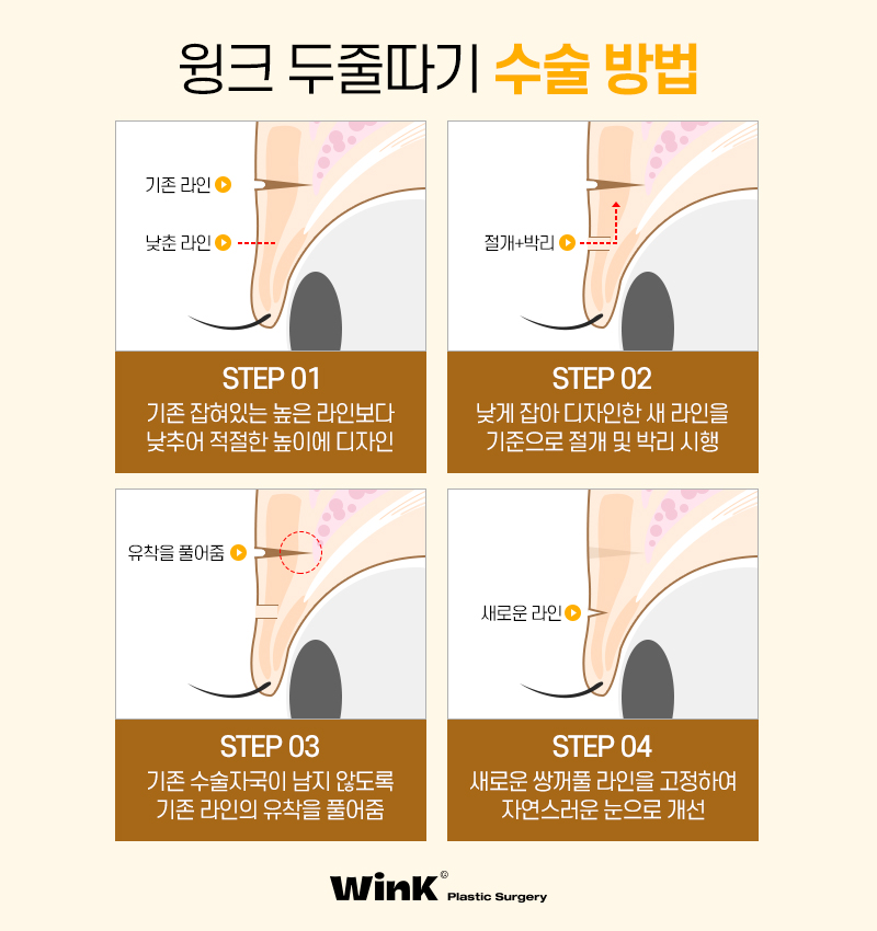 소세지눈 재수술, 두줄따기로 라인 낮추기 관련 이미지 7