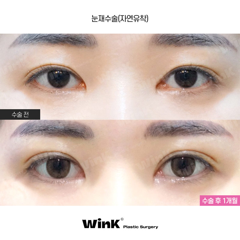 윙크 자연유착재수술로 자연스럽고 확실한 고정! 관련 이미지 1