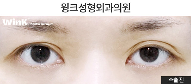 Case Examples of Correcting Uneven Eyes Through Ptosis Correction image 7