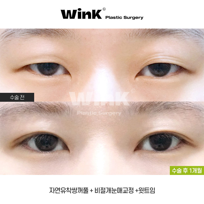 Non-incisional Eye Correction Review: A Natural, Clear Eye Shape! image 1
