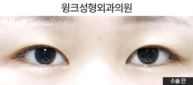 자연유착 쌍꺼풀에 대해 알아보겠습니다. 관련 이미지 2