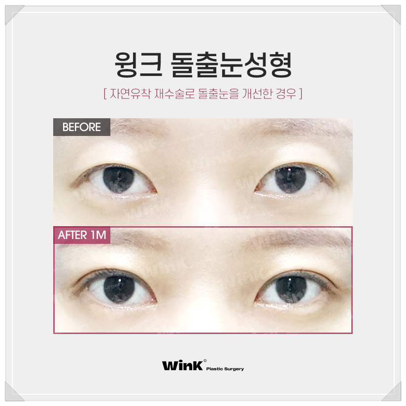 Post-Op Review of Protruding Eyes Surgery, Sunken Eye Fat Grafting, Wink Plastic Surgery Upper Eyelid Fat Repositioning Price, Protruding Eye Fat Grafting image 5