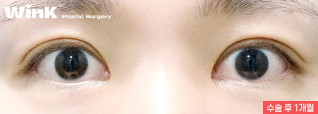 Wink Plastic Surgery Double Eyelid Revision Surgery, Pursuing Natural Results by Identifying the Exact Cause of Failure image 7