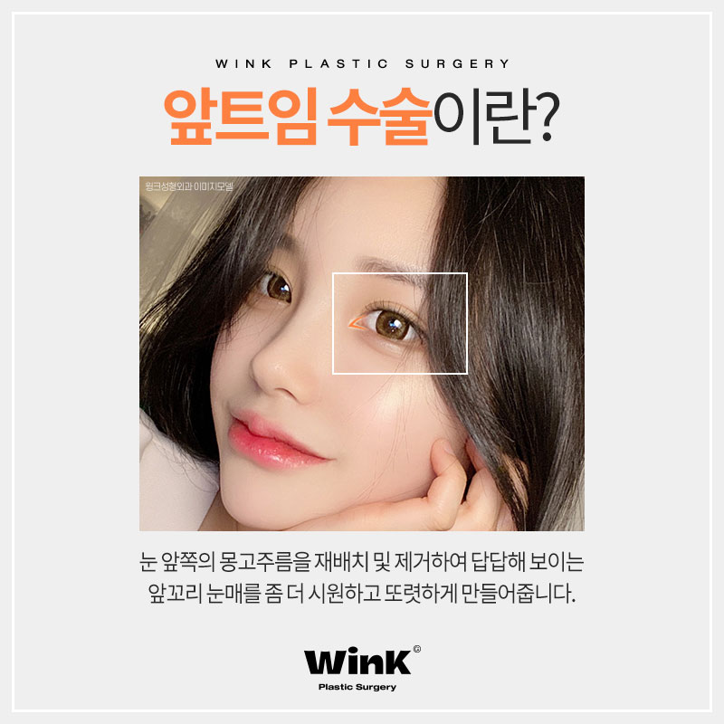 트임맛집 알아보고 있다면 윙크성형외과 신사앞트임비용 관련 이미지 2