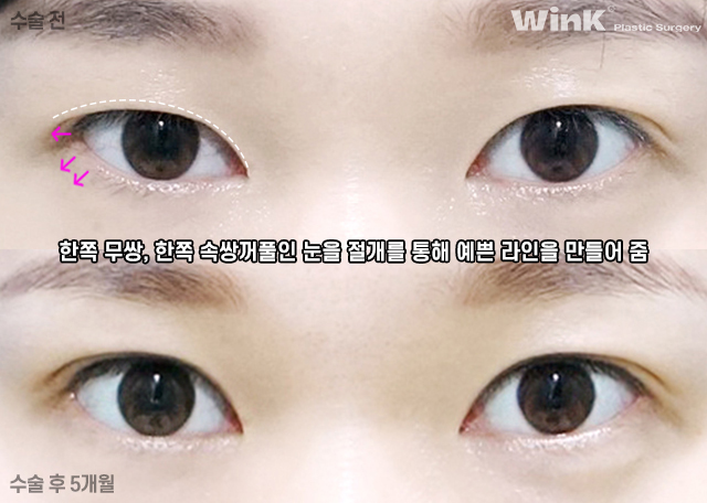 What Are the Important Factors for Successful Revision Eye Surgery? image 7