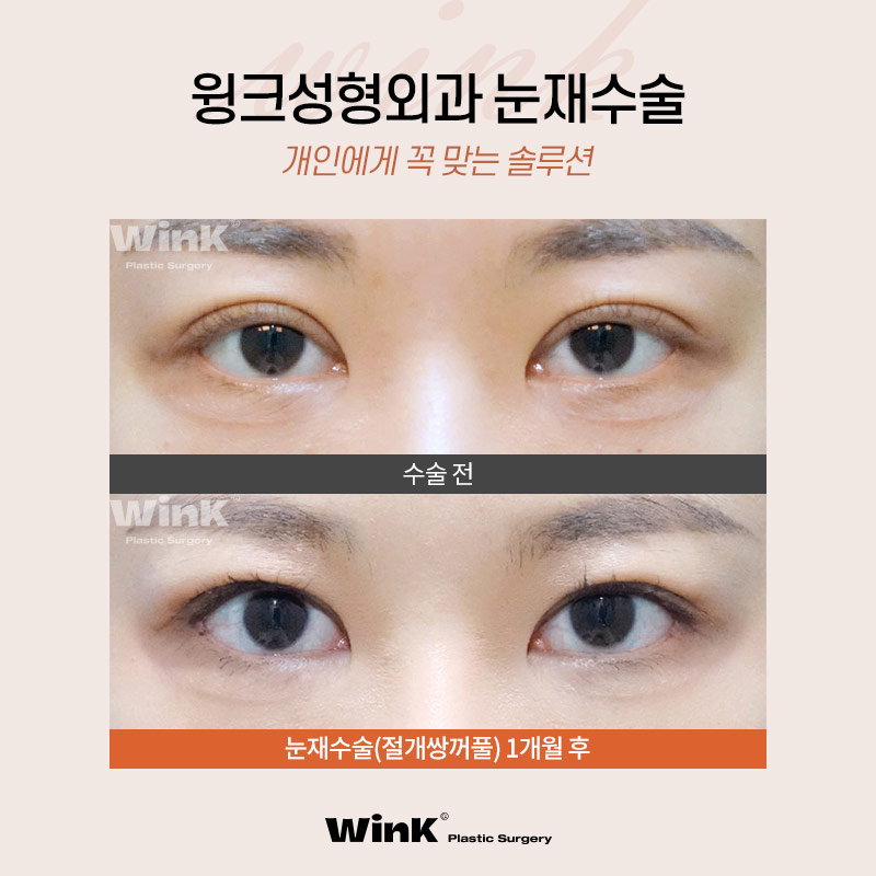 윙크성형외과에서 알려드리는  다양한 실패원인! 눈재수술후기 신사눈재수술잘하는곳 관련 이미지 5