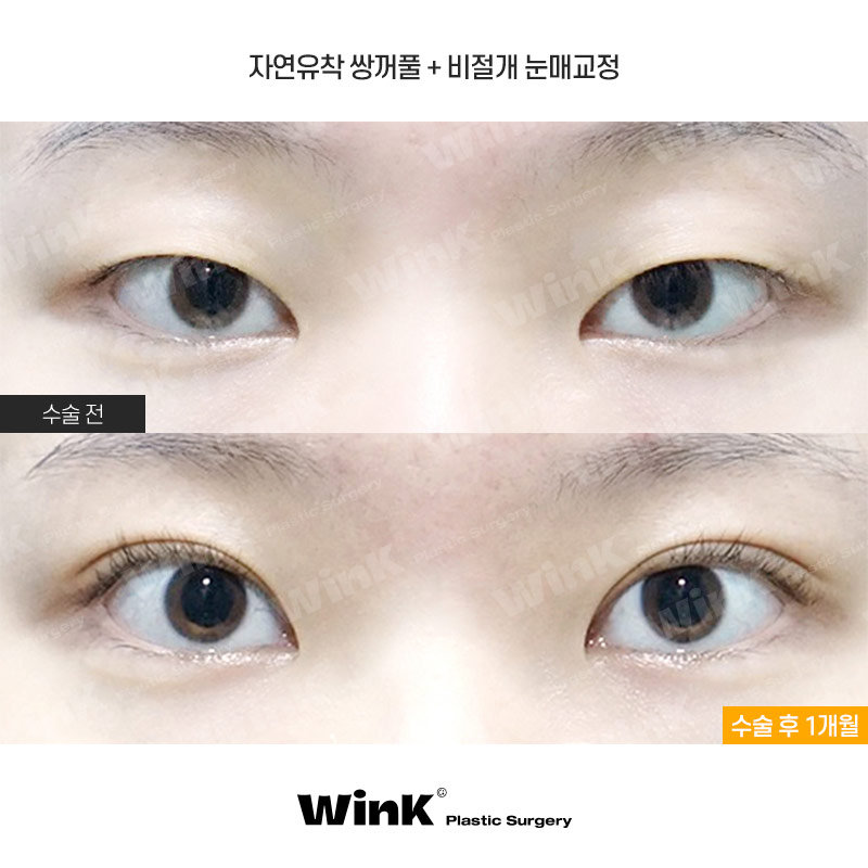 Wink Plastic Surgery’s Non-Incisional Ptosis Correction for Clearer Eyes Without an Incision! image 1