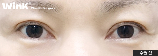 Improve Droopy Eyes with Wink Middle-Age Eyelid Surgery! image 6