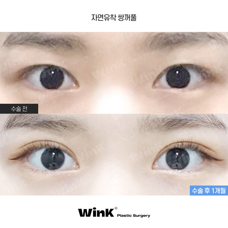 Can I Have My Eyes Surgery Done with Natural Adhesion Too? image 1