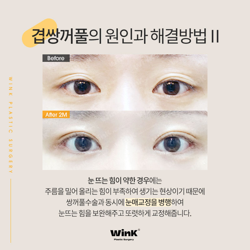 윙크성형외과에서 알려드리는 겹쌍꺼풀과 눈 뜨는 힘이 중요한 이유! 관련 이미지 5