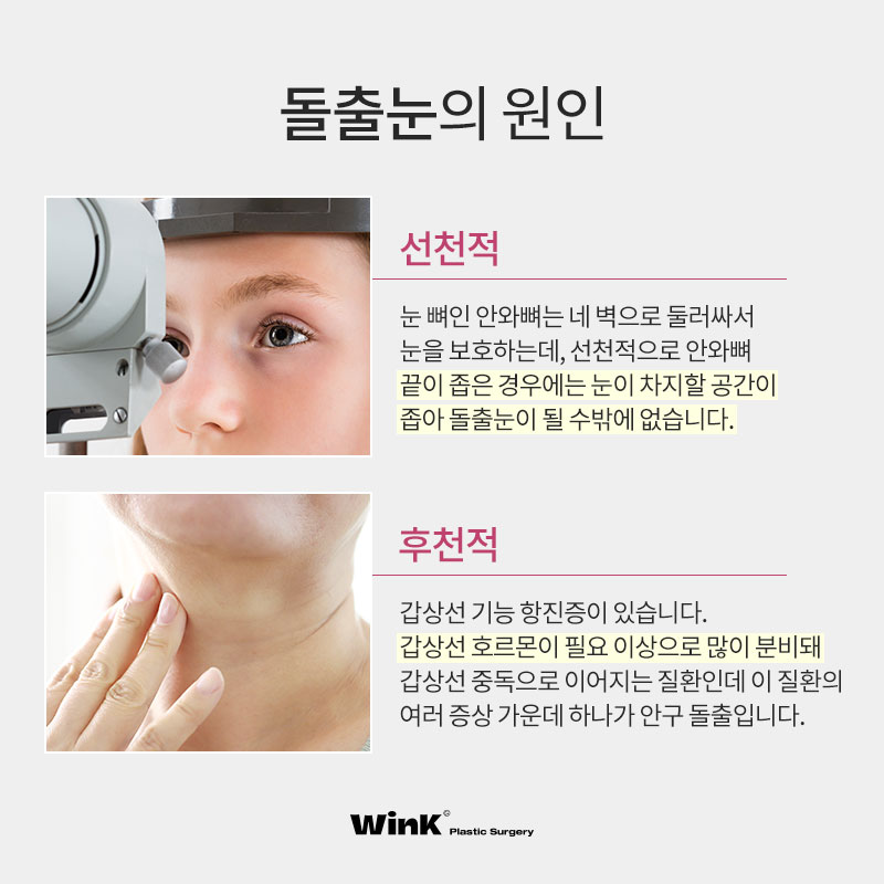내 눈은 안구가 앞으로 튀어나온 돌출눈? 윙크성형외과에서 알려드리는 돌출눈성형 진단법! 관련 이미지 3