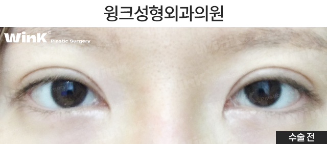 소세지눈 재수술, 두줄따기로 라인 낮추기 관련 이미지 2