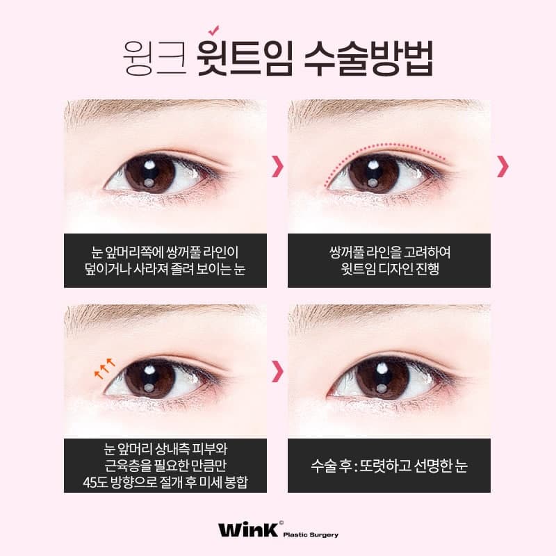 Subtly Enhancing the Eyes with Wink Plastic Surgery’s Upper Epicanthoplasty! image 5