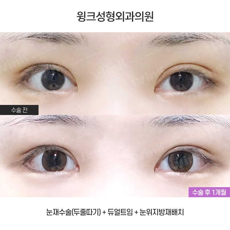 Make a Fierce Eye Shape Look Gentle with Outer and Lower Corner Eye Surgery! image 1