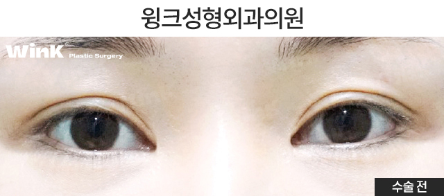 Let’s Learn About Double-Eyelid Revision Surgery with an Incision for a Thick Front Line image 6