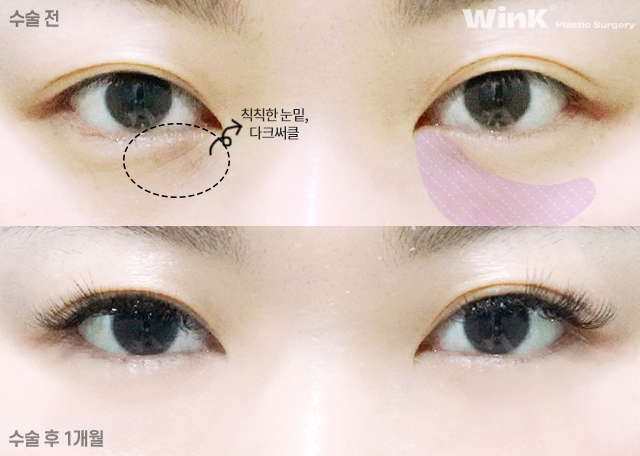 Lower Eyelid Fat Repositioning: Who Is It Effective For? image 4