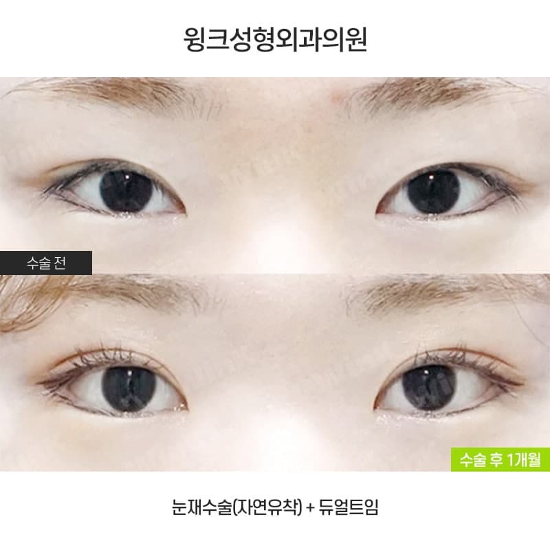 나도 자연유착으로 재수술 할 수 있을까? 관련 이미지 1