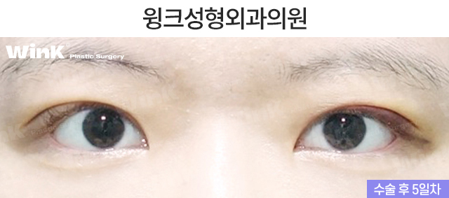 절개 눈매교정 쌍꺼풀 수술에 대해 알아볼까요? 관련 이미지 6