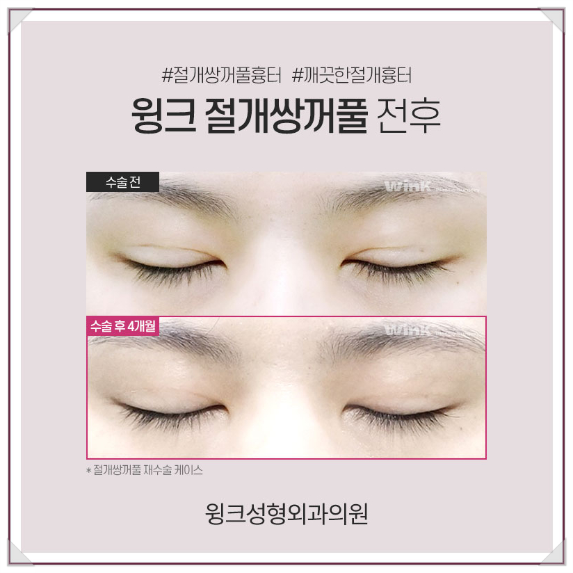 Incisional Double Eyelid Surgery: A Natural Line Without Worrying About Scars Even After Surgery! image 8