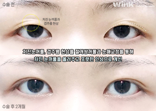 Let’s Learn About Incisional Double Eyelid Surgery. image 7