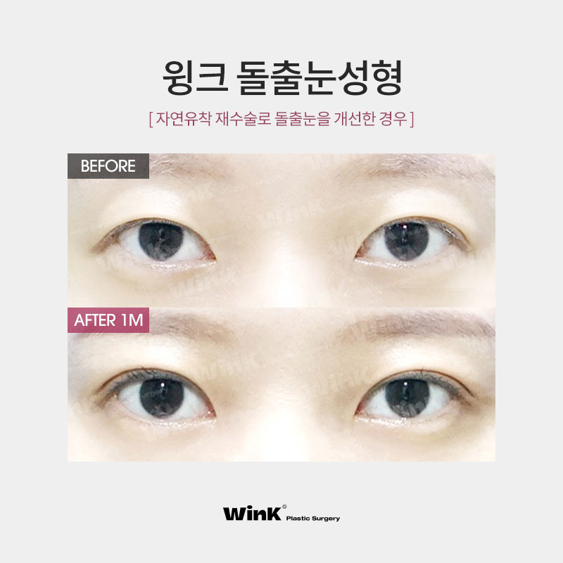 내 눈은 안구가 앞으로 튀어나온 돌출눈? 윙크성형외과에서 알려드리는 돌출눈성형 진단법! 관련 이미지 5