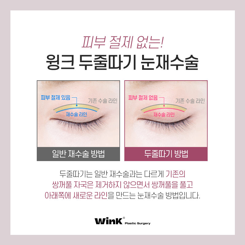 두껍고 높은 소세지눈? 윙크성형외과 두줄따기 눈재수술로 개선 관련 이미지 4