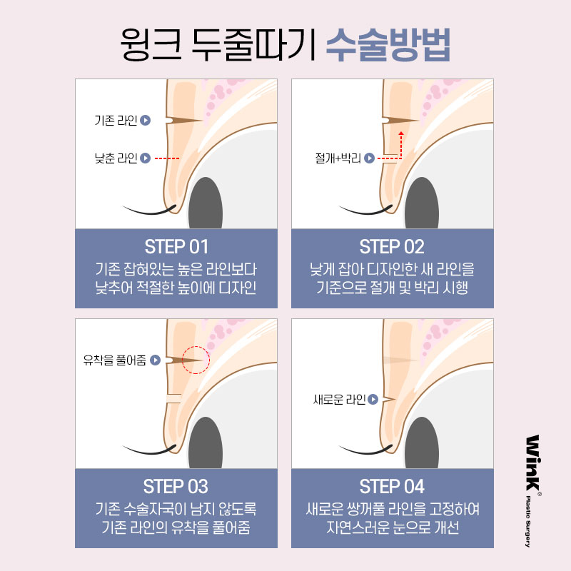 Thick, High Double Eyelid Lines and a Sausage-Like Eye! Solve It with Wink Double-Line Revision Surgery! image 4