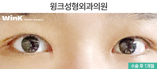 Let's Learn About Male Eye Correction and Eye Plastic Surgery image 3