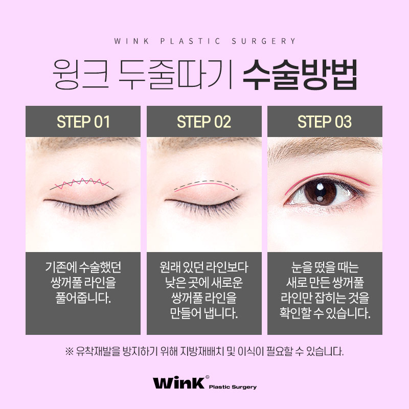 쌍꺼풀비후증(소세지눈), 윙크성형외과 두줄따기로 자연스럽게! 관련 이미지 5