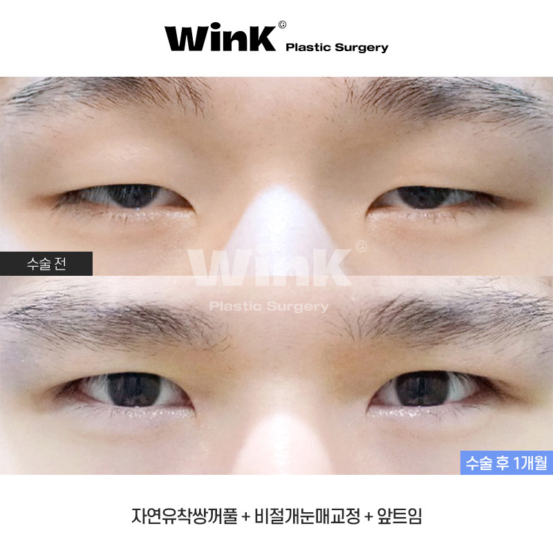 Monolid, inner double eyelid, or outer double eyelid? Choose the line that suits you! Men’s eye surgery at Wink Plastic Surgery image 1