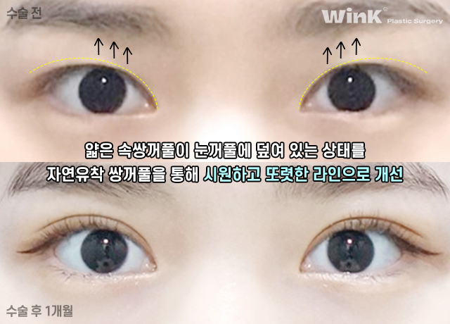 Can I Have My Eyes Surgery Done with Natural Adhesion Too? image 2