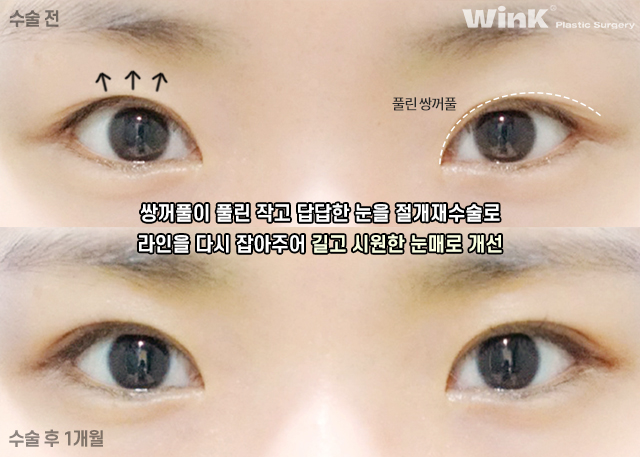 How Should Double Eyelid Surgery Be Performed for Small, Narrow Eyes? image 4