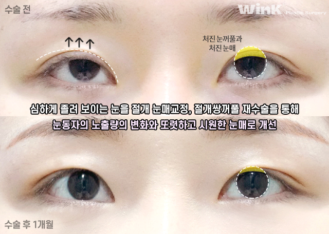 Let’s Take a Look at Double Eyelid Surgery for Droopy Eyes. image 4