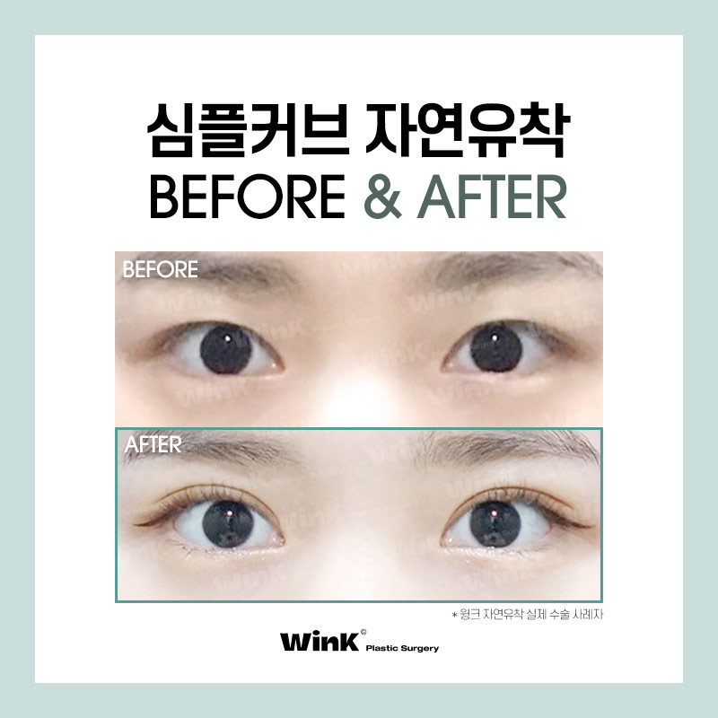 윙크성형외과만의 심플커브 자연유착으로 자연스럽고 매끈한 곡선 라인! 관련 이미지 4