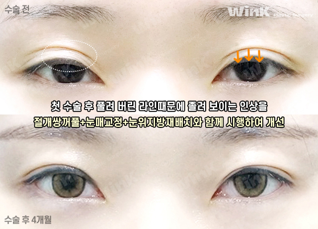Lowering the Double Eyelid Line: Making Thick Double Eyelids (Sausage Eyes) Look Natural with a Two-Line Revision Surgery! image 5