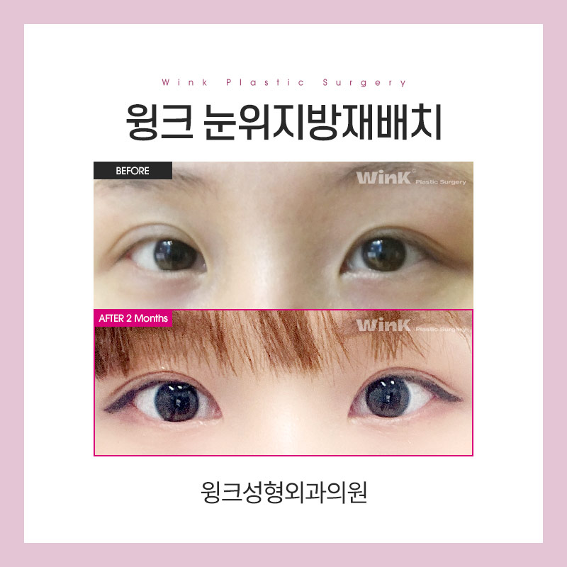 눈위 지방재배치에 대해 알아보겠습니다. 관련 이미지 6