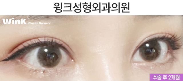 Make a Fierce Eye Shape Look Gentle with Outer and Lower Corner Eye Surgery! image 6