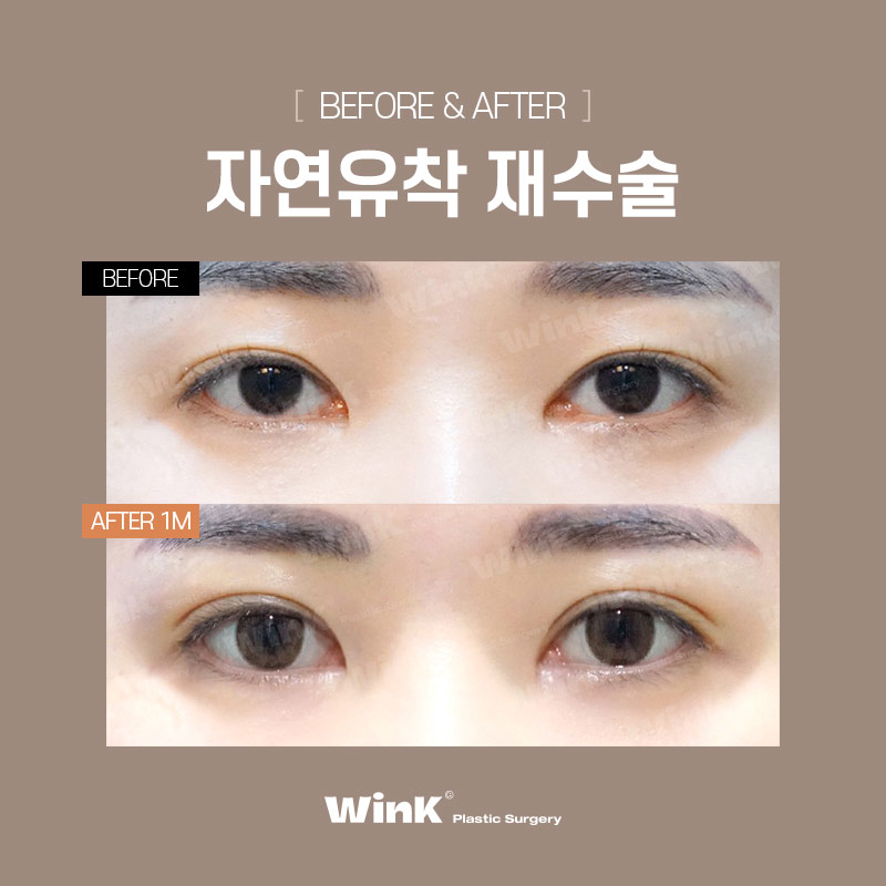 Wink Plastic Surgery’s Natural Adhesion Revision Surgery to Put an End to Further Failures! image 4