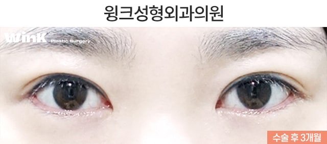 듀얼트임으로 자연스럽게 눈을 키우는 방법에 대해 알아볼까요? 관련 이미지 3