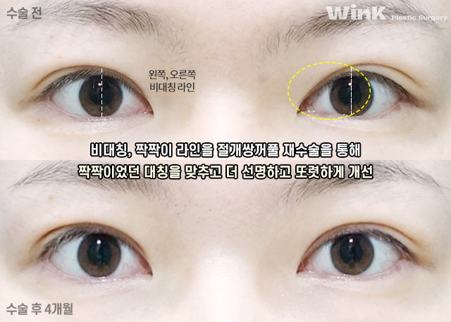 Shall We Learn About Revision Double Eyelid Surgery? image 4