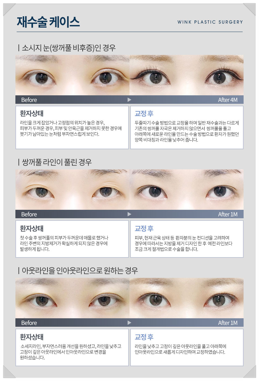 눈성형잘하는곳 신사눈재수술유명한곳 윙크성형외과 최승협원장님 눈성형명의 관련 이미지 9