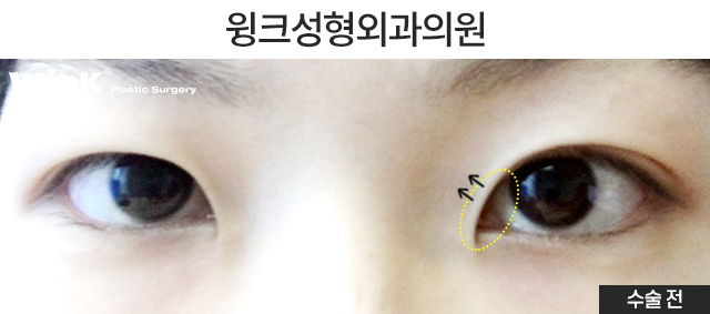 Let’s Take a Look at the Changes and Effects Before and After Upper Epicanthoplasty image 8