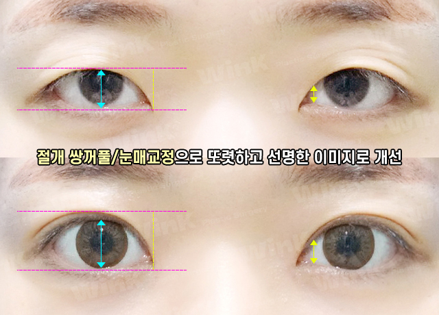 If you want to create the double eyelid line you want without being limited by your eye shape, Wink Incision Double Eyelid Surgery! image 6