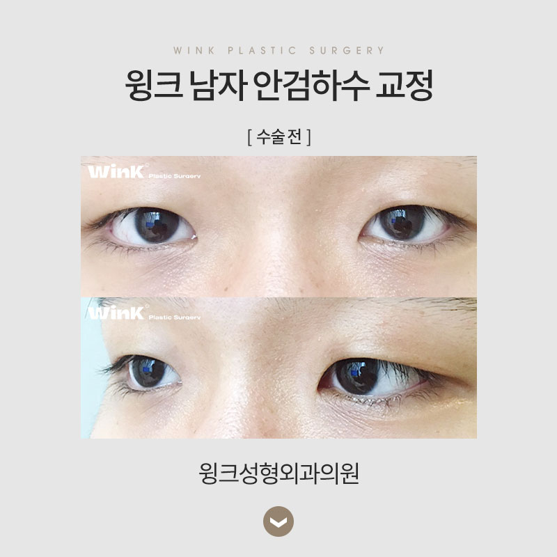 남자 안검하수 교정에 관해 알아보겠습니다. 관련 이미지 4