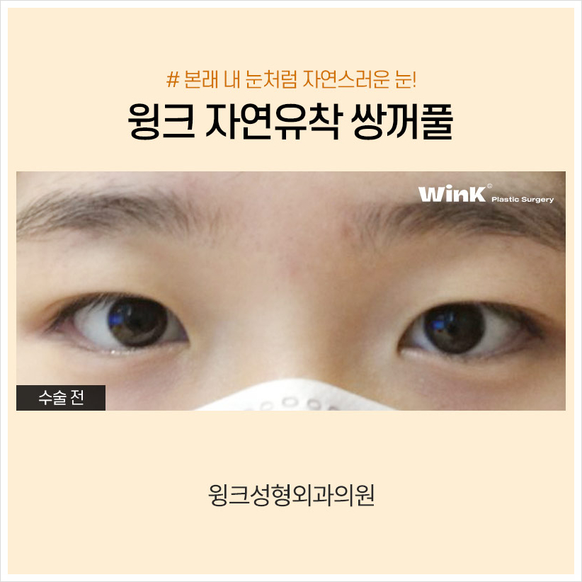 인라인쌍꺼풀 윙크성형외과 자연유착쌍꺼풀후기 자연유착법 관련 이미지 3