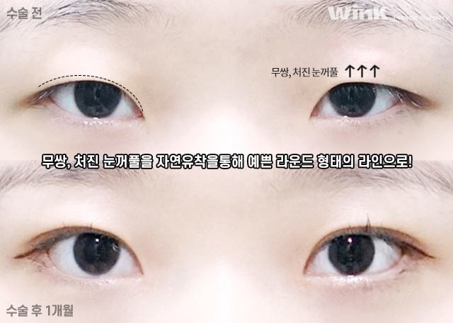 인라인 자연유착 쌍꺼풀 수술에 대해 알아볼까요? 관련 이미지 4