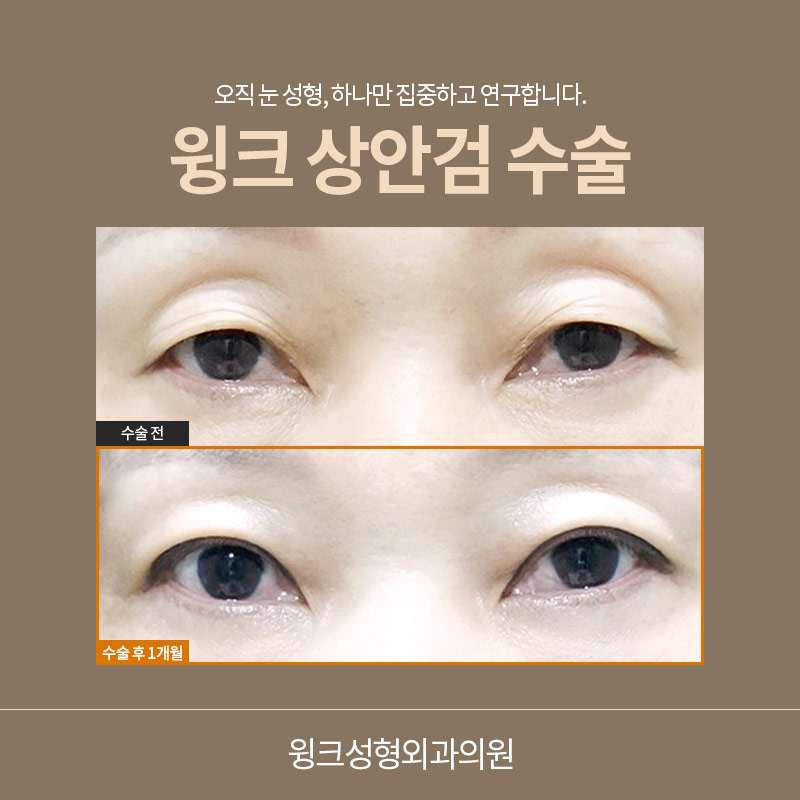If You Want Upper Eyelid Surgery to Look Natural image 5
